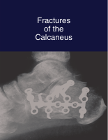 Fractures of the calcaneus.pdf